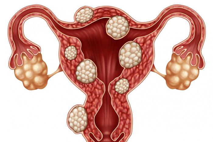 Fibroids Aur Iske Lakshan Kya Hain?