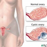Gynecological Open Surgeries in Indore
