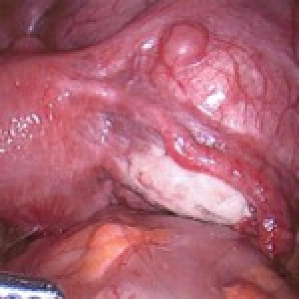 Best Laparoscopic Surgeon in Indore